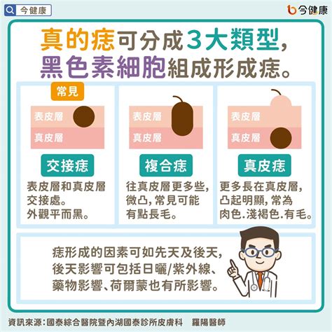 內痣是什麼|是痣？皮膚癌？還是什麼？常見Q&A解惑！醫教揪出「假的痣」